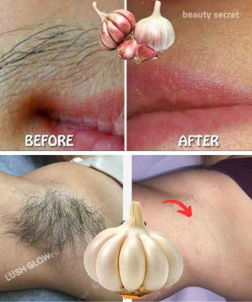 Stop Shaving! Here’s How to Permanently Get Rid of Facial, Body, and Pubic Hair with Garlic