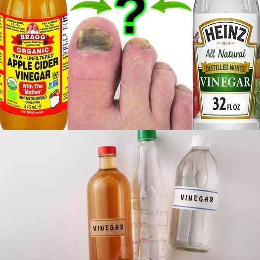 White Vinegar vs. Apple Cider Vinegar for Toenail Fungus: Which is Better