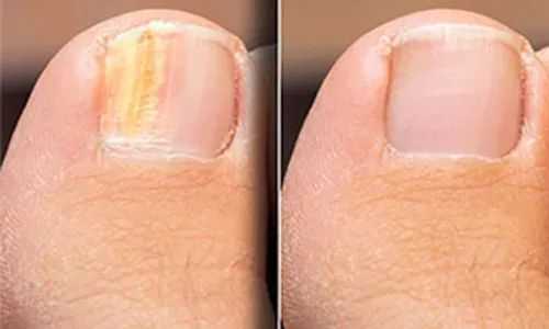 Garlic: A Natural Remedy for Fungal Foot Infections