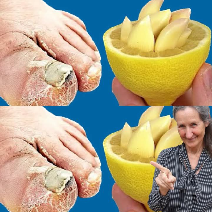 Natural Treatment For Toenail Fungus