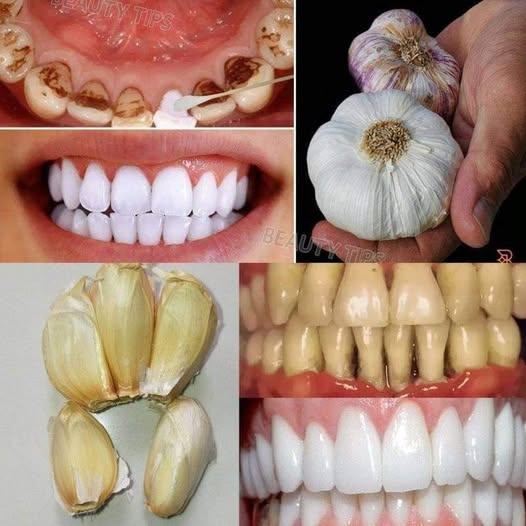 Secrets that dentists want to hide from you: With garlic you can remove tartar and whiten your teeth in just 2 minutes ‎‎