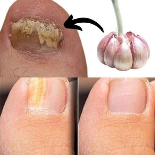 Garlic: A Natural Remedy for Fungal Foot Infections