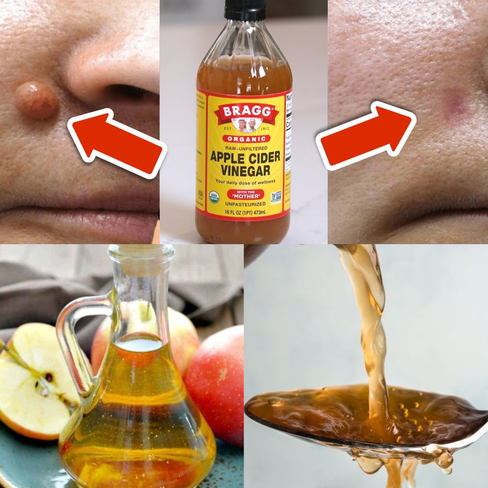 Apple cider vinegar removes warts in just 24 hours