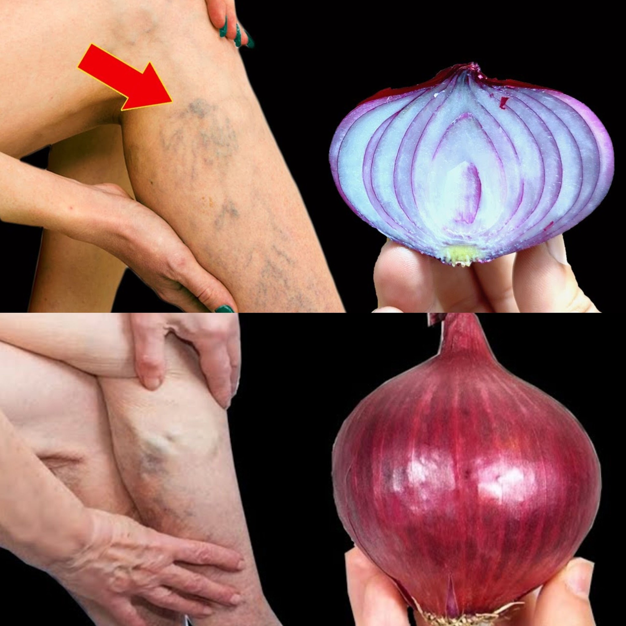  Unbelievable! It’s a Varicose Vein Killer! Erases Varicose Veins Like an Eraser – Red Onion Remedy