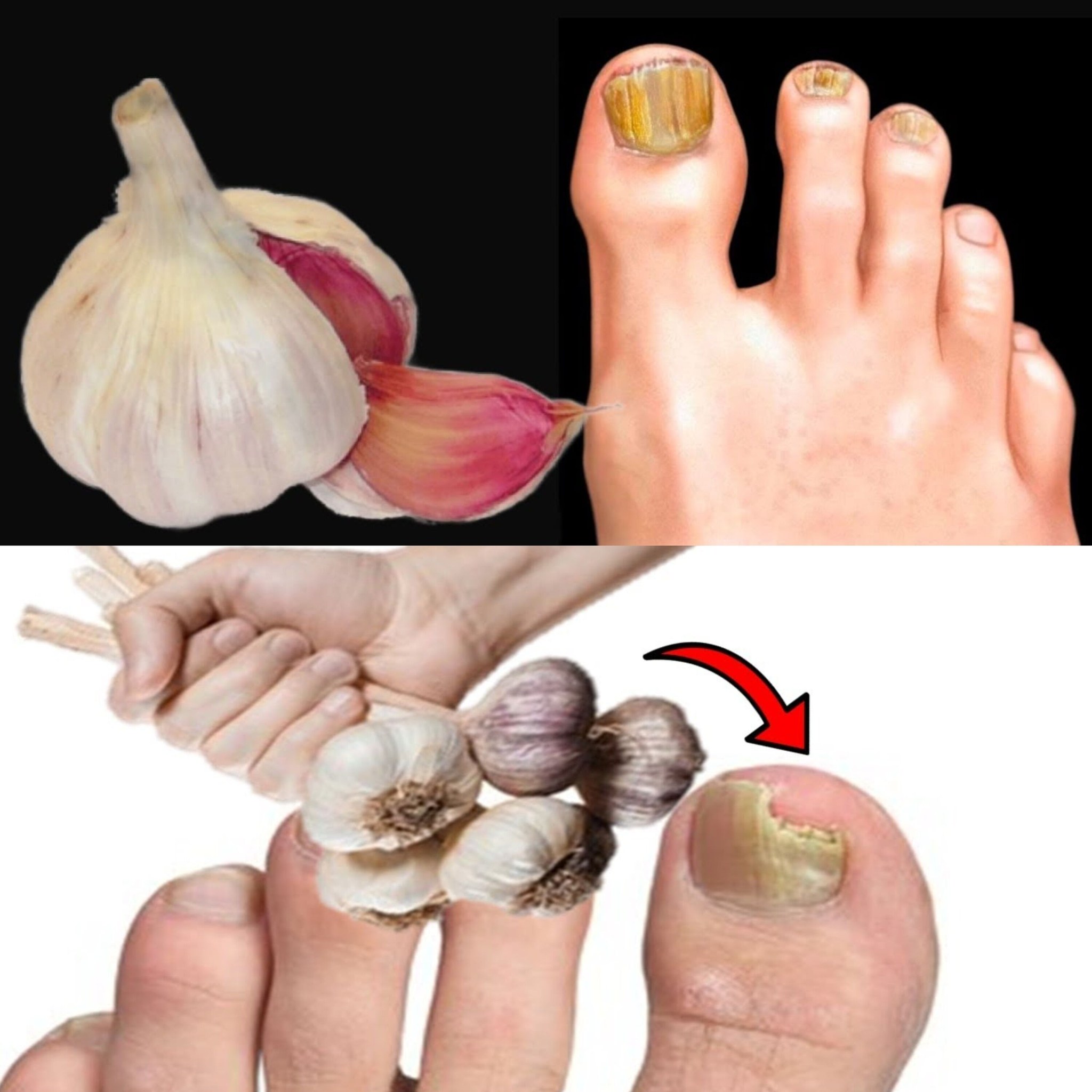 Instantly removes nail fungus like an eraser! The best natural remedy! Efficiency 