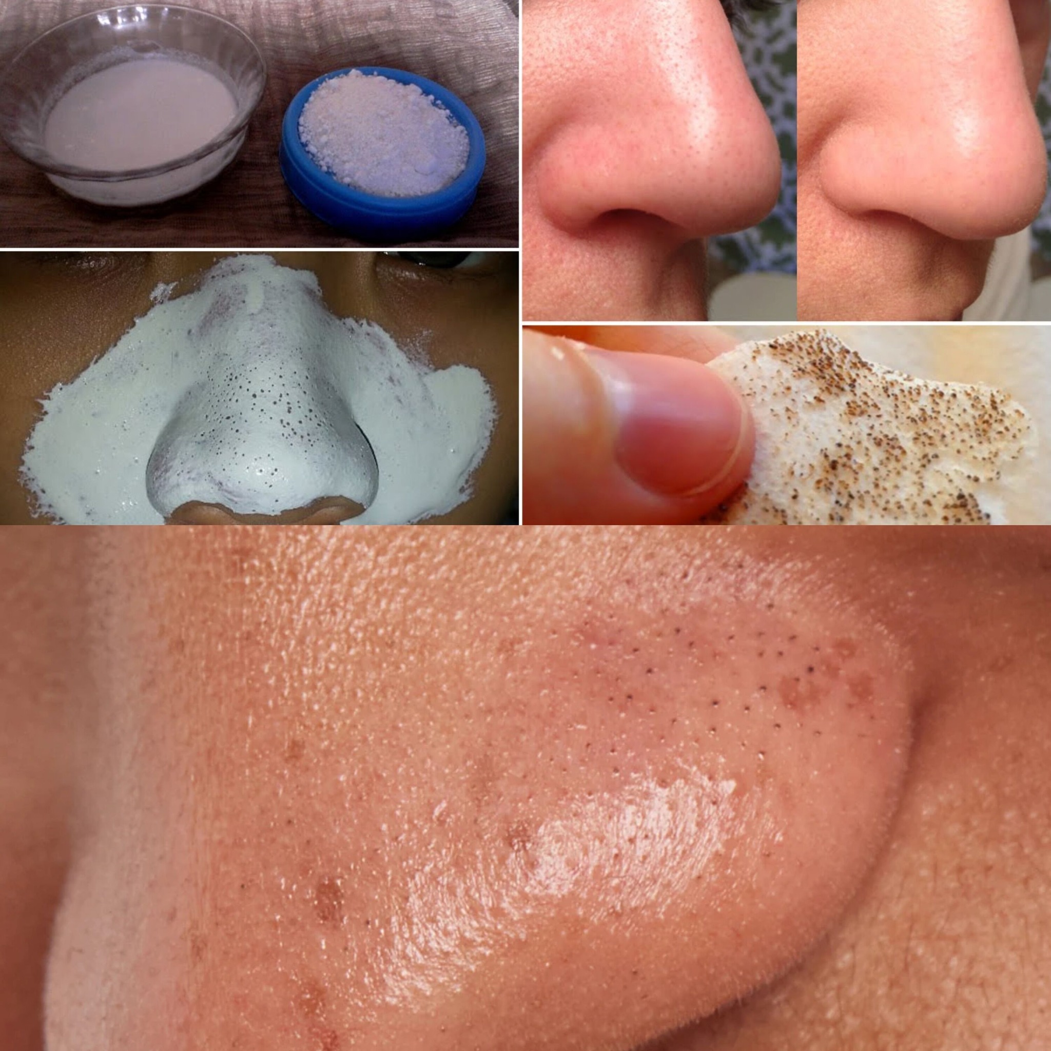 Remove All Your Blackheads And Whiteheads