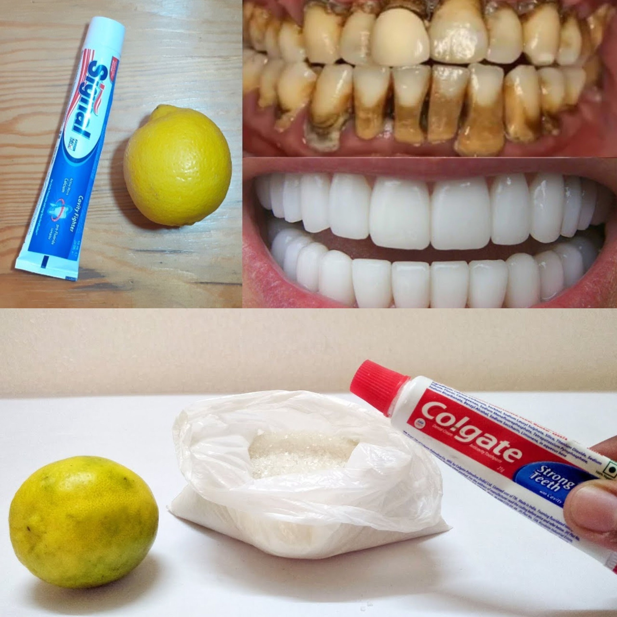 Natural Mixture for Yellow Teeth Whitening at Home in One Day Without a Dentist: A Proven Method with Toothpaste and Lemon