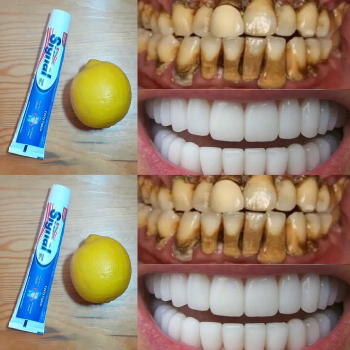 Natural Teeth Whitening at Home in One Day